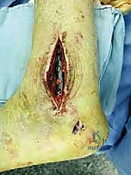 الأربطة المحيطة بالكاحل