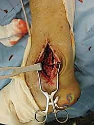 هيكل المفصل الصناعي القديم