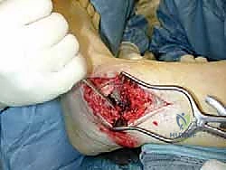 صورة طبية: مراجعة مفصل الكاحل الصناعي (Agility) وعلاج كسور الكعب: دليل شامل للمرضى