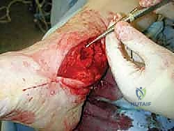 صورة طبية: مراجعة مفصل الكاحل الصناعي (Agility) وعلاج كسور الكعب: دليل شامل للمرضى