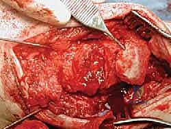 صورة طبية: مراجعة مفصل الكاحل الصناعي (Agility) وعلاج كسور الكعب: دليل شامل للمرضى