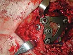 دعامة الكاحل التحفظية