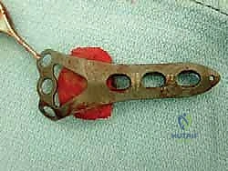 صورة طبية: مراجعة مفصل الكاحل الصناعي (Agility) وعلاج كسور الكعب: دليل شامل للمرضى