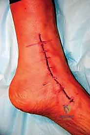 صورة توضيحية لـ مراجعة مفصل الكاحل الصناعي (Agility) وعلاج كسور الكعب: دليل شامل للمرضى