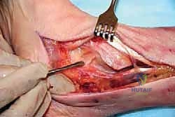 فحص سريري للكاحل المتورم