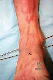 إدخال المفصل الجديد