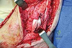 التئام الكسر بعد الجراحة