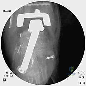 مقطع من التصوير المقطعي للكاحل