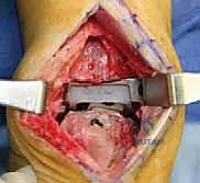 صورة طبية: مراجعة مفصل الكاحل الصناعي (Agility) وعلاج كسور الكعب: دليل شامل للمرضى