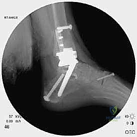صورة طبية: مراجعة مفصل الكاحل الصناعي (Agility) وعلاج كسور الكعب: دليل شامل للمرضى