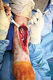 صورة طبية: مراجعة مفصل الكاحل الصناعي (Agility) وعلاج كسور الكعب: دليل شامل للمرضى