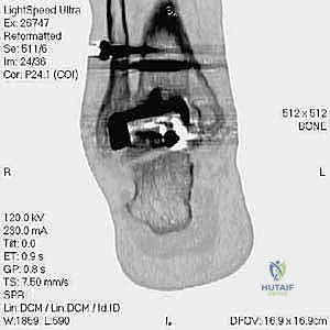 صورة توضيحية لـ مراجعة مفصل الكاحل الصناعي (Agility) وعلاج كسور الكعب: دليل شامل للمرضى