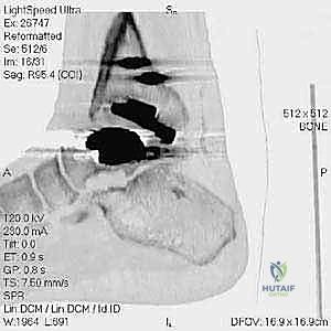 صورة توضيحية لـ مراجعة مفصل الكاحل الصناعي (Agility) وعلاج كسور الكعب: دليل شامل للمرضى