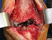 تقييم المدى الحركي للمفصل