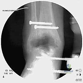 إزالة مكونات المفصل القديم