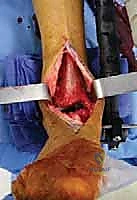 ملاحظة انحراف الكاحل