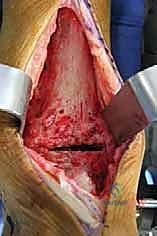 صورة توضيحية لـ مراجعة مفصل الكاحل الصناعي (Agility) وعلاج كسور الكعب: دليل شامل للمرضى