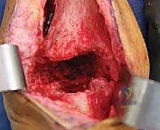 صورة طبية: مراجعة مفصل الكاحل الصناعي (Agility) وعلاج كسور الكعب: دليل شامل للمرضى