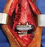 تخطيط لعملية دمج الكاحل