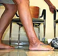 صورة طبية: مراجعة مفصل الكاحل الصناعي (Agility) وعلاج كسور الكعب: دليل شامل للمرضى