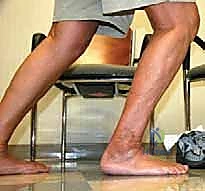 صورة طبية: مراجعة مفصل الكاحل الصناعي (Agility) وعلاج كسور الكعب: دليل شامل للمرضى