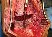 عدوى موضعية حول المفصل