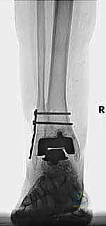 إغلاق الجرح التجميلي