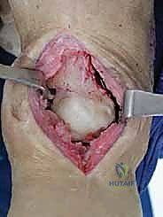 صورة توضيحية لـ مراجعة مفصل الكاحل الصناعي (Agility) وعلاج كسور الكعب: دليل شامل للمرضى