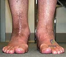 تحليل المخزون العظمي المتبقي