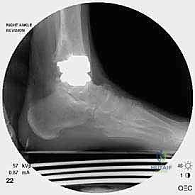 صورة طبية: مراجعة مفصل الكاحل الصناعي (Agility) وعلاج كسور الكعب: دليل شامل للمرضى