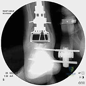 صورة شعاعية توضح التثبيت المعقد