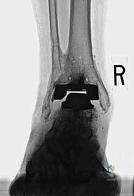 FIG 15 This patient seen in Tech Fig 8 decided to forgo revision surgery and continued to bear full weight on the cement spacer A