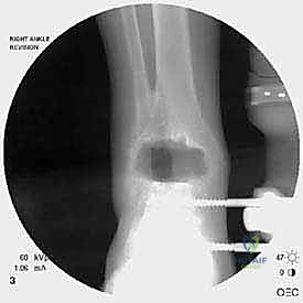 فحص الاستقرار الميكانيكي