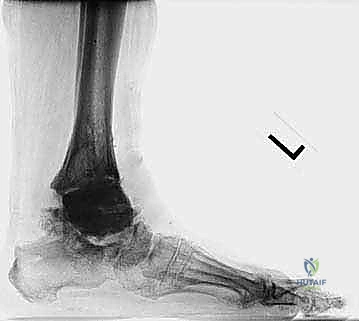 FIG 15 This patient seen in Tech Fig 8 decided to forgo revision surgery and continued to bear full weight on the cement spacer A