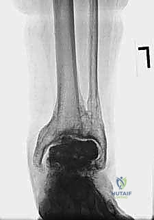 FIG 15 This patient seen in Tech Fig 8 decided to forgo revision surgery and continued to bear full weight on the cement spacer A