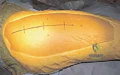 Surgical Dislocation of the Hip: A Masterclass in Femoroacetabular Impingement Correction