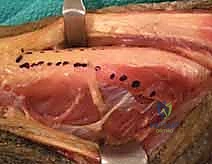 علامات سقوط الرسغ وعدم القدرة على بسط الأصابع