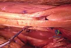 شرح مبدأ تحويل الأوتار للمريض قبل الجراحة