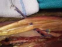 الخطوة الأولى: عزل وتر العضلة الكابة المدورة