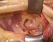 صورة توضيحية لـ شلل العصب الكعبري وتحويل الأوتار: استعادة حركة اليد والذراع مع الأستاذ الدكتور محمد هطيف في صنعاء