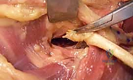 صورة توضيحية لـ شلل العصب الكعبري وتحويل الأوتار: استعادة حركة اليد والذراع مع الأستاذ الدكتور محمد هطيف في صنعاء