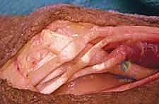 صورة طبية: شلل العصب الكعبري وتحويل الأوتار: استعادة حركة اليد والذراع مع الأستاذ الدكتور محمد هطيف في صنعاء