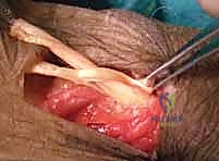 صورة توضيحية لـ شلل العصب الكعبري وتحويل الأوتار: استعادة حركة اليد والذراع مع الأستاذ الدكتور محمد هطيف في صنعاء