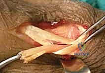 صورة طبية: شلل العصب الكعبري وتحويل الأوتار: استعادة حركة اليد والذراع مع الأستاذ الدكتور محمد هطيف في صنعاء