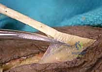 صورة توضيحية لـ شلل العصب الكعبري وتحويل الأوتار: استعادة حركة اليد والذراع مع الأستاذ الدكتور محمد هطيف في صنعاء