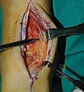 صورة توضيحية لجراحة الكاحل المتقدمة