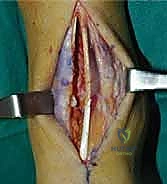 صورة طبية: تثبيت مفصل الكاحل الأمامي: حل فعال لخشونة الكاحل المزمنة مع الأستاذ الدكتور محمد هطيف