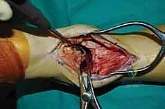 التصوير المقطعي للكاحل