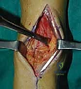 الأربطة الداعمة للكاحل