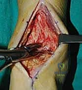 الأستاذ الدكتور محمد هطيف أثناء الجراحة